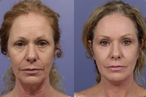 Before and After of Women - Over 40+ After Using Synevra UltraLift